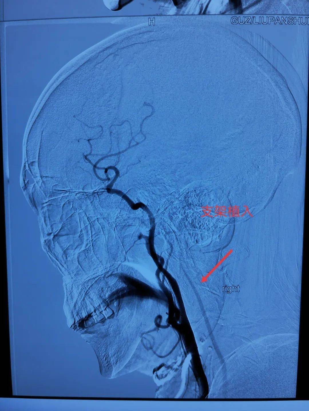 小小支架撑开生命通道